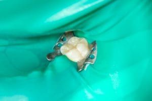 Green dental dam around single tooth