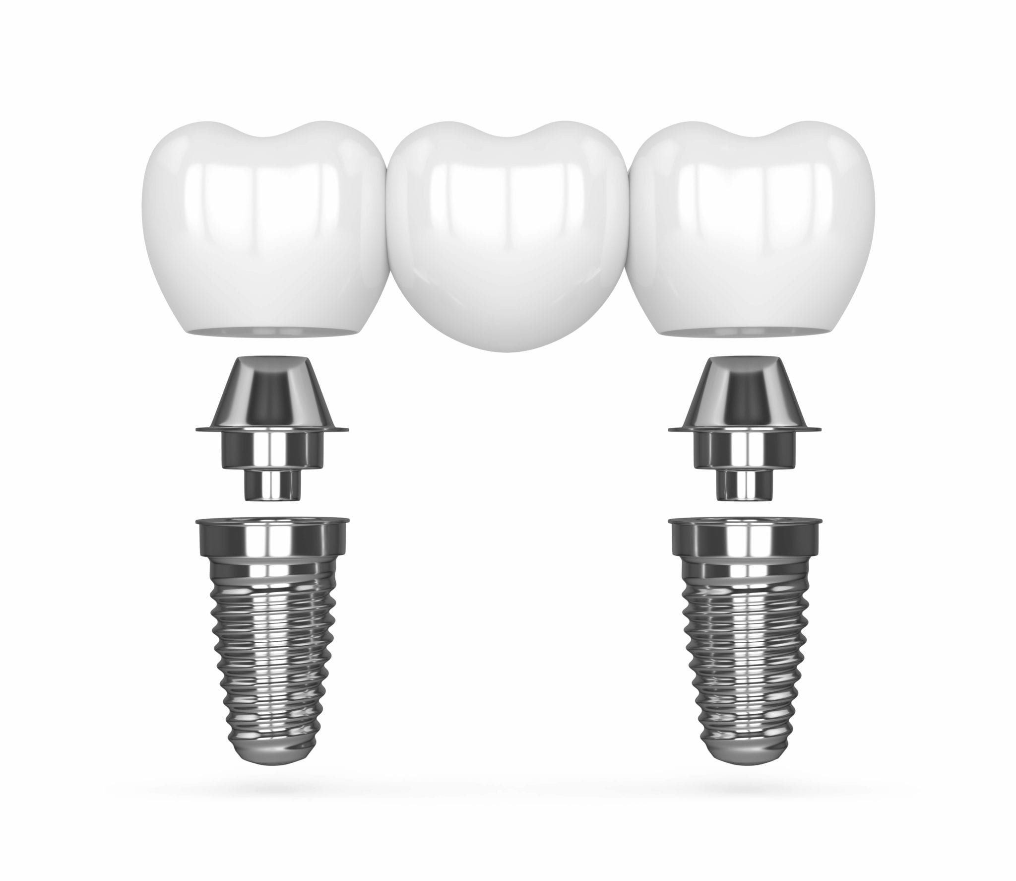 crowns-and-bridges-magnolia-dental