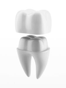Model of a dental crown