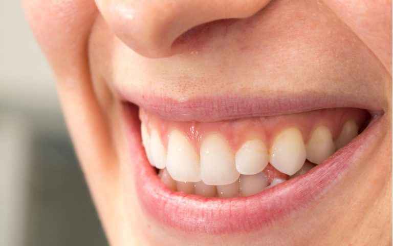 woman smiling with healthy teeth