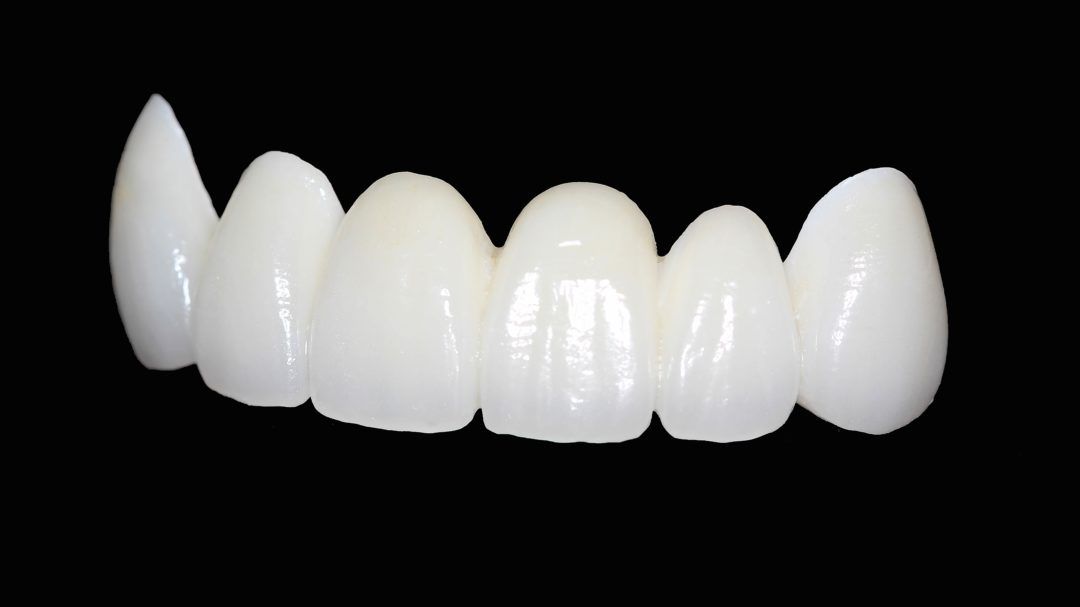 what-are-zirconia-crowns-magnolia-dental