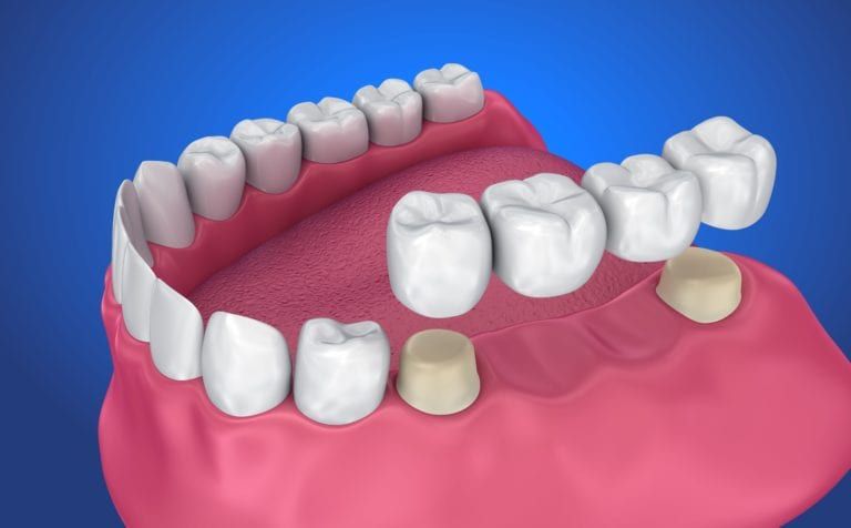 Different Types of Dental Crowns and Bridges