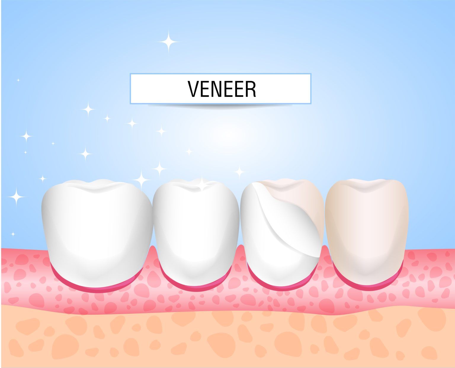 Traditional Veneers vs. Lumineers - Magnolia Dental