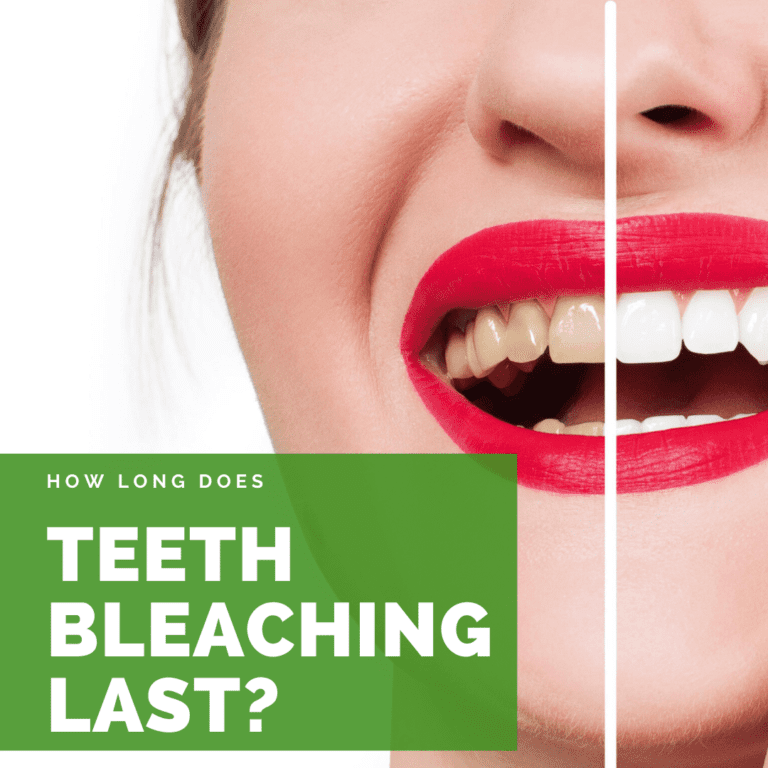 How Long Does Teeth Bleaching Last?